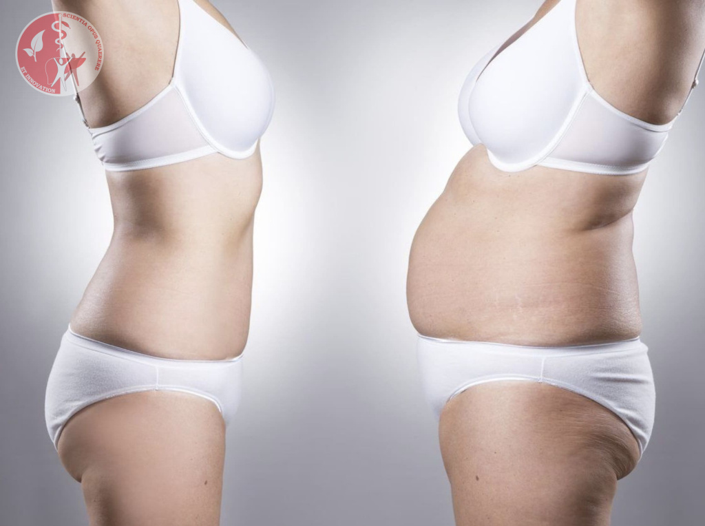 операция по уменьшению бёдер и живота операция по уменьшению бёдер и живота