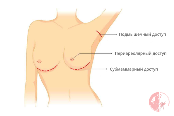 особенности пластики груди особенности пластики груди