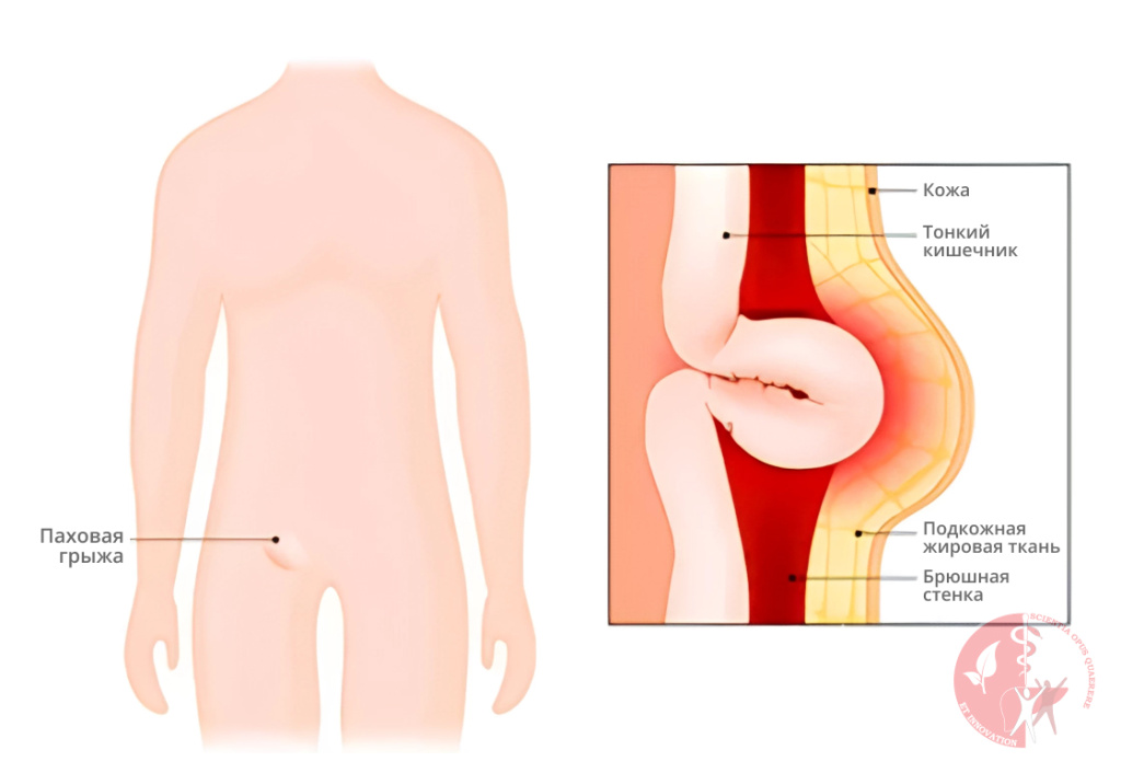 операция паховой грыжи операция паховой грыжи