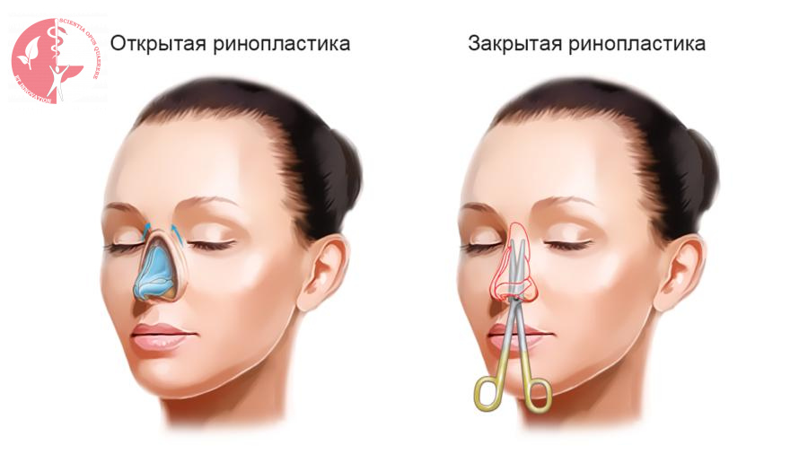 Как выглядит нос после септопластики Ринопластика, хирургическая коррекция формы носа в Минске - Цены