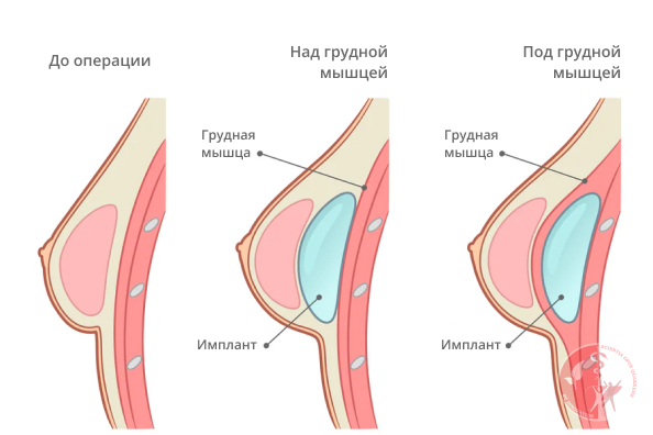 методы увеличения груди методы увеличения груди