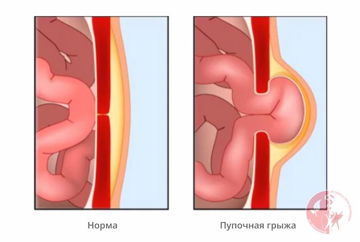 лечение пупочной грыжи лечение пупочной грыжи