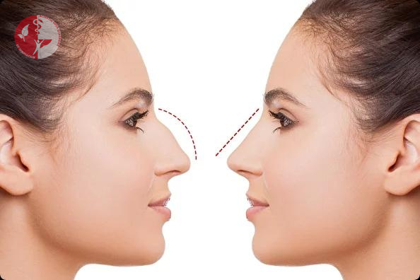 ринопластика операция ринопластика операция