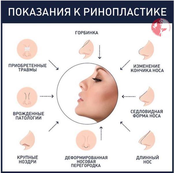 показания к ринопластике показания к ринопластике