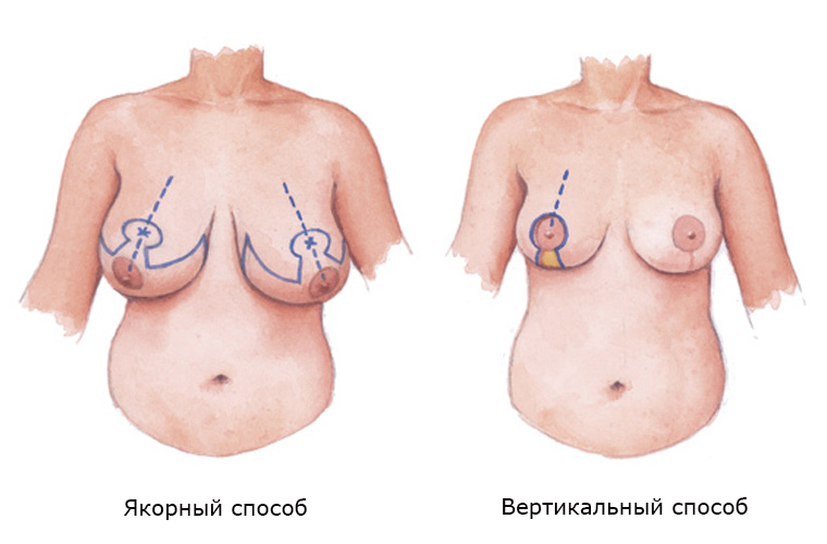 способы уменьшения груди способы уменьшения груди